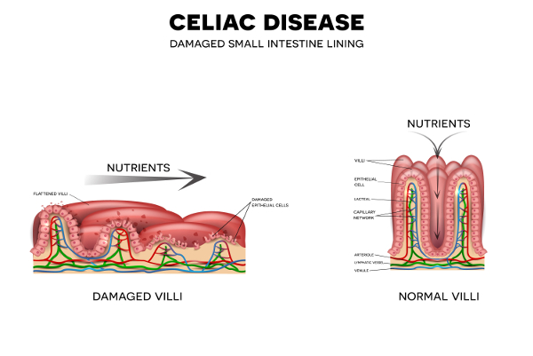 celiac diagram